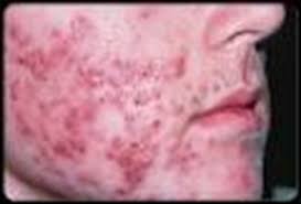 We did not find results for: Mrsa Infektionserkrankungen
