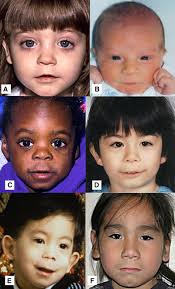 Fetal Alcohol Spectrum Disorders What Pediatric Providers Need To Know Journal Of Pediatric Health Care