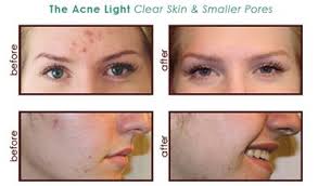 This Light Helps To Relive Skin That Is Plagued By The Small Bumps Blemishes And Redness Optimal Results Can Rosacea Skin Care Rosacea Symptoms Acne Rosacea
