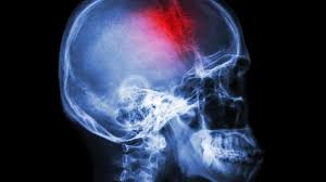 Image result for Brain Lesion