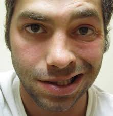 Learn more about bell's palsy treatment, including bell's palsy massage and acupuncture for bell's palsy. Bell S Palsy Causes Treatment And Symptoms