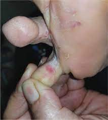 Another remedy in the list of top 25 home remedies for diaper rash is shea butter. Giving A Rash The Boot Clinician Reviews