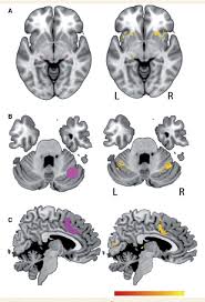 Image result for Neurologic Lesion Localization
