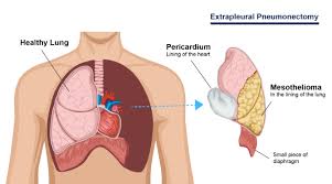Sufferers of peritoneal mesothelioma may also experience pain in the abdominal area. Mesothelioma Treatment Top 3 Treatments For Mesothelioma