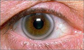 Cholesterol And The Eye Eyedolatry