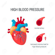 High blood pressure, also called hypertension, has no warning signs or symptoms. High Blood Pressure Concept Human Heart And Arteries Elements Royalty Free Cliparts Vectors And Stock Illustration Image 120182487
