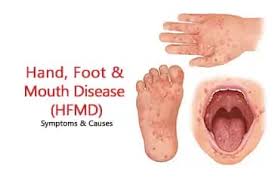 Image result for Hand foot and mouth disease HFMD roof of mouth