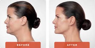 Patients often describe this as a double chin. older patients often have fullness under the chin as well as some loose skin. Double Chin Treatments Vancouver Belkyra Treatments In Vancouver Burnaby Coquitlam