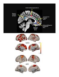 Nitrous Oxide Alters Functional Connectivity in Medial Limbic Structures in  Treatment-Resistant Major Depression