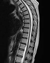 Jan 14, 2017 · transverse myelitis is an inflammatory condition of the spinal cord associated with rapidly progressive neurologic dysfunction. Transverse Myelitis Evolution In Mri Radiology Case Radiopaedia Org