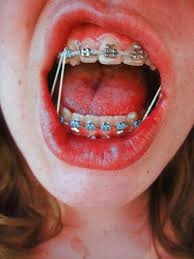 Searching For Why Braces Rubber Bands Effectiveness And Working Of Rubber Bands And Here You Will Find Relevan Braces Rubber Bands Teeth Braces Dental Braces