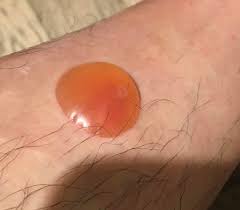 My mosquito bite. I am allergic and it looks worse than it actually is. :  rpopping