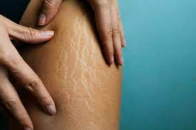 None Of My Stretch Marks Are From Being Pregnant But I M Embracing Them Anyway Health Com