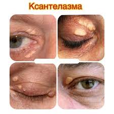 📌 Ксантома (ксантелазма) — это доброкачественное ...