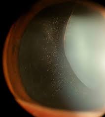 Image result for Lens Dislocation