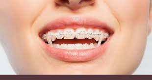 Know how long it could take. How Long To Wear Rubber Bands For Braces Chatham Orthodontics