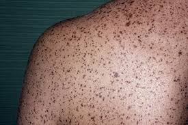 Image result for Freckled skin