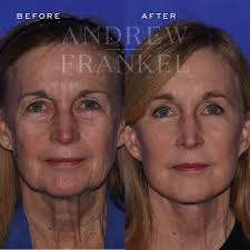 Andrew S. Frankel, MD, FACS (@drandrewfrankel) • Instagram photos and videos