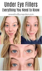 Dermal fillers are one of the most popular aesthetic treatments in singapore; Under Eye Fillers For Dark Circles Before After Under Eye Fillers Undereye Cheek Fillers