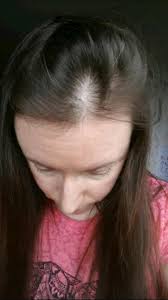 Most people who notice more hair loss after starting levothyroxine find that it lasts only a month or two. Hair Loss Is This Normal My Tsh Was 9 28 In May Thyroid Uk