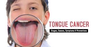 5 throat cancer signs & symptoms to learn before treatment (first pictures). Tongue Cancer Stages Causes Symptoms Preventions