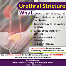 Image result for Urethral Stricture