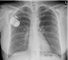 Lesen sie mehr über ablauf und mögliche risiken einer. Abstract 193 52 Jahrige Patientin Mit Ratchet Syndrom Nach Reimplantation Eines Implantierbaren Kardioverter Defibrillators