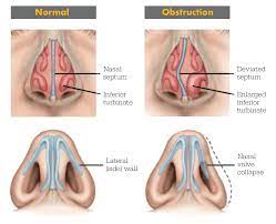 Nasal Airway Obstruction Ent Stryker