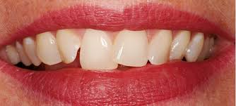 Meus Dentes Da Frente Sao Tortos Posso Usar Aparelho Rma Odontologia