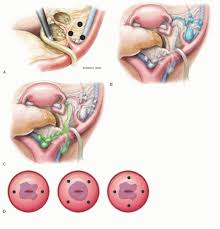 Image result for Friable Cervix