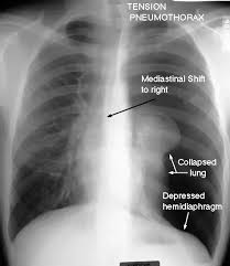 Collapsed lung, also called pneumothorax, occurs when air fills the pleural space that surrounds the lungs. How Are Punctured Lungs Diagnosed Quora