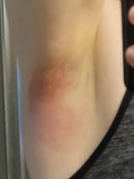 I have been doing weight watchers fir the last year and have lost 60 pounds  so far. I am 15 pounds from goal of 130. I now have bat wings and my