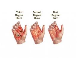 1st degree sunburn is one that only affects the outer layer of the skin (epidermis). 28 Burns Ideas Burns Degree Burns Burns Treatment