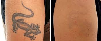 Tattoo removal creams can fade tattoos but they will rarely remove them. Tattoo Removal By Laser Body Matters Warebody Matters Ware