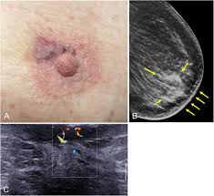 Stage 4, or metastatic, breast cancer means the cancer has spread to other parts of the body. Multimodality Approach To The Nipple Areolar Complex A Pictorial Review And Diagnostic Algorithm Insights Into Imaging Full Text