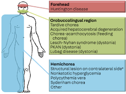 Image result for Chorea