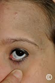 Image result for nevus sclerae