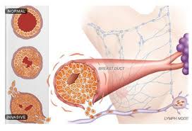Stage 4 breast cancer refers to the spread of breast cancer beyond the area of the breast and surrounding lymph nodes, debu tripathy, md, professor instead, metastatic breast cancer often emerges months or years after someone has already completed treatment for an initial breast cancer. Breast Cancer Survival Rates By Stage 4 Stages Chart How To Prevent