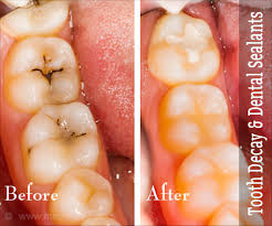 It's a quick and painless process. Prevent Tooth Decay In Children By Using Dental Sealants