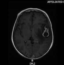 Image result for Brain Abscess