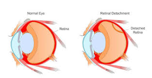 Image result for Retinal Detachment