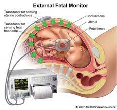 Quantitative nitroblue tetrazolium test in chronic granulomatous 149. Non Stress Test Nst Hartfordhospital Org Hartford Hospital