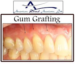 During Gum Graft Surgery Your Periodontist Takes Gum Tissue From Your Palate Or Another Donor Source To Cover The Exposed Root This Can Be Done For One Tooth