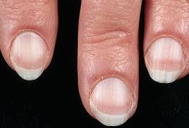 What Your Fingernails Say About Your Health Ridges Spots