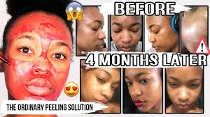 Like ahas, salicylic acid dissolves the glue that holds skin cells together so they can slough off. I Tried The Ordinary Peeling Solution For 3 Weeks Youtube Cute766