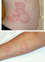 Zona zoster afecteaza in mod special persoanele cu un sistem imunitar slabit. Ciuperci De Piele Tipuri De Ciuperci De Piele È™i Metode De Tratament Allergodermatosis