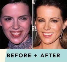 Check spelling or type a new query. Can Botox Fix My Gummy Smile Belfast Dublin Cork And Killarney Sisu