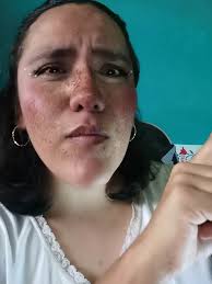 Alexander Roe Ciego Se Recupera