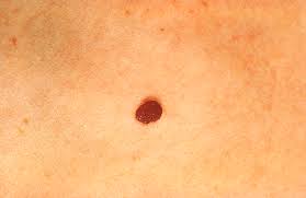 Le praticien va retirer entièrement le grain de beauté puis faire des points de sutures profonds avec des fils. Ne Vous Faites Pas Enlever Vos Grains De Beaute Au Laser