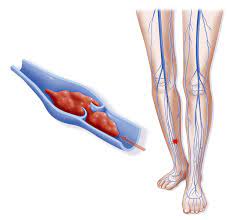 Why You Should Wear Compression Socks On Your Next Flight Compression Socks Benefits Compression Socks Compression Stockings